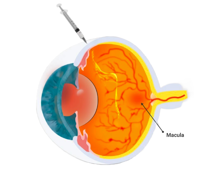 Injections intra-vitréennes (IVT)